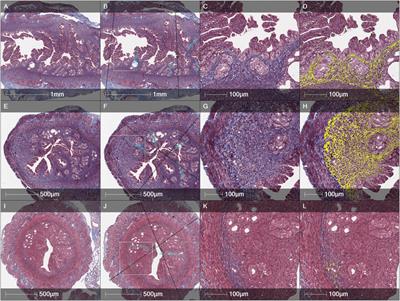 Human endometrium-derived mesenchymal stem/stromal cells application in endometrial-factor induced infertility